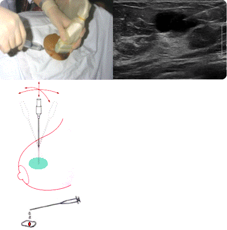 초음파 유도 하에 실시간 바늘과 병소의 위치를 확인하며, 가는 바늘로 낭종을 흡입하고 있다.